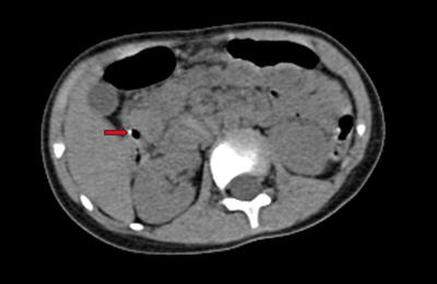 Laparoscope combined with ureteroscope in the treatment of bile duct stones and cholecystolithiasis in a child: a case report and literature review